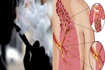 مصرف سیگار الکترونیکی و خطر ابتلا به سرطان ریه